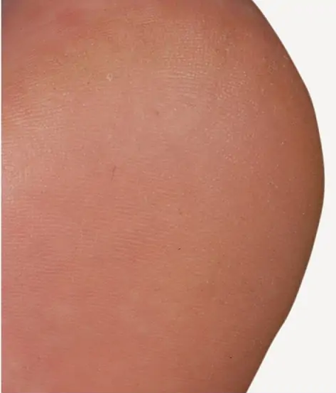 Nachherbild Hornhaut