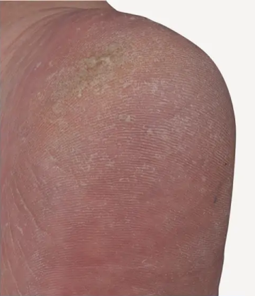 Bild von abnehmender Hornhaut